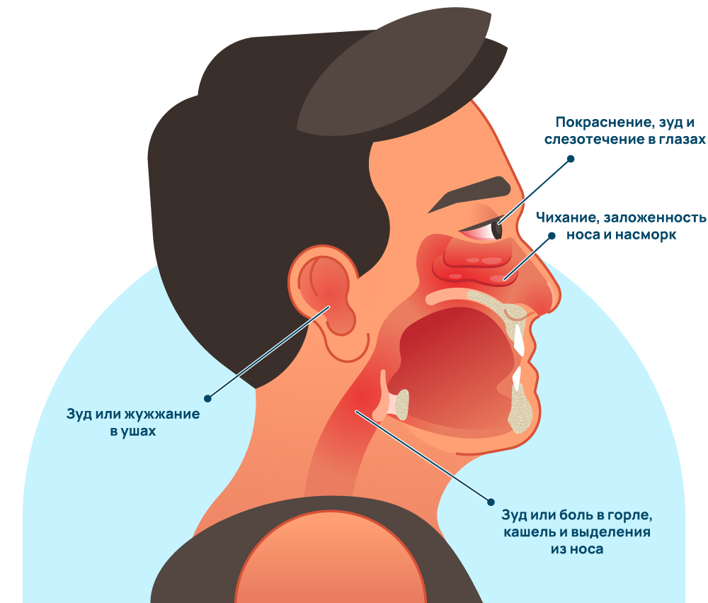 Симптомы аллергического ринита
