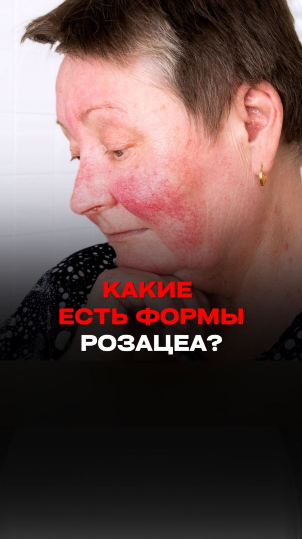 КАКИЕ ЕСТЬ ФОРМЫ РОЗАЦЕА?