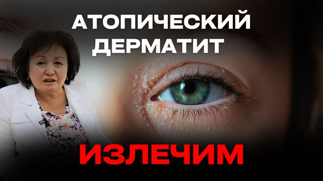 АТОПИЧЕСКИЙ ДЕРМАТИТ - ИЗЛЕЧИМ