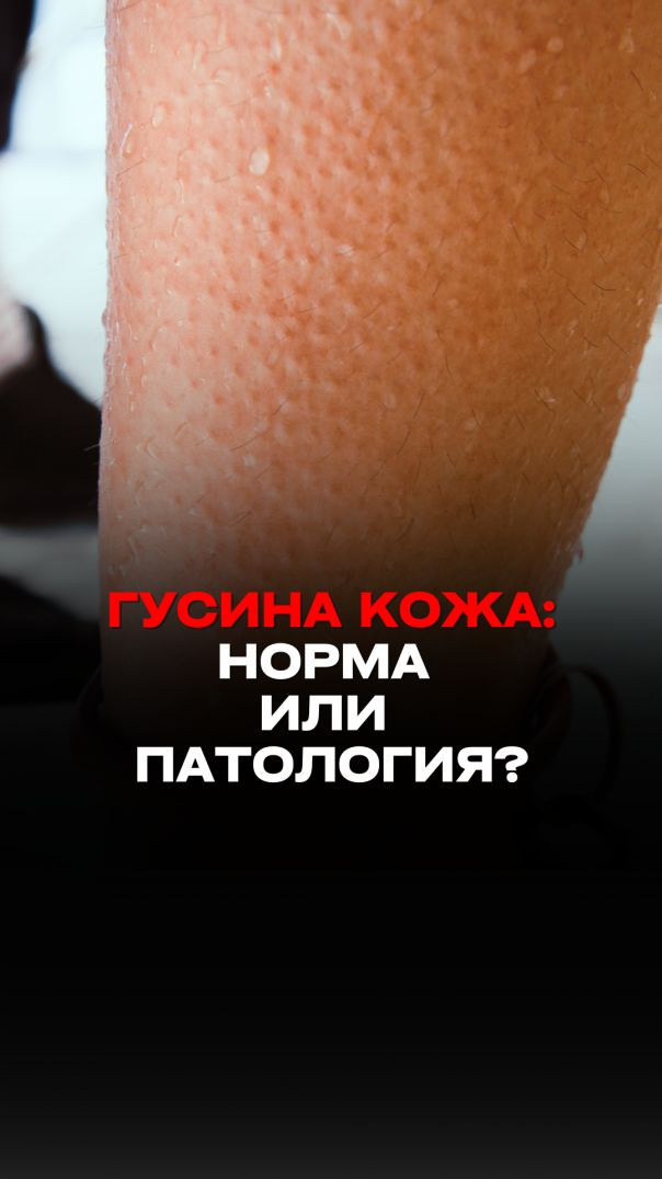 ГУСИНАЯ КОЖА: НОРМА ИЛИ ПАТОЛОГИЯ? Тизер