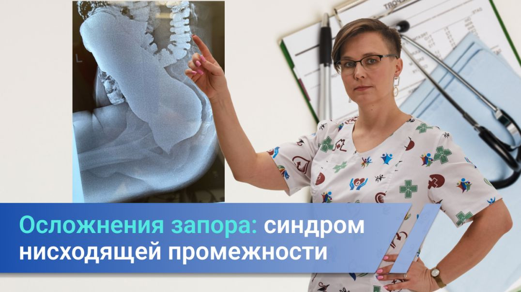 Осложнения запора - синдром нисходящей промежности