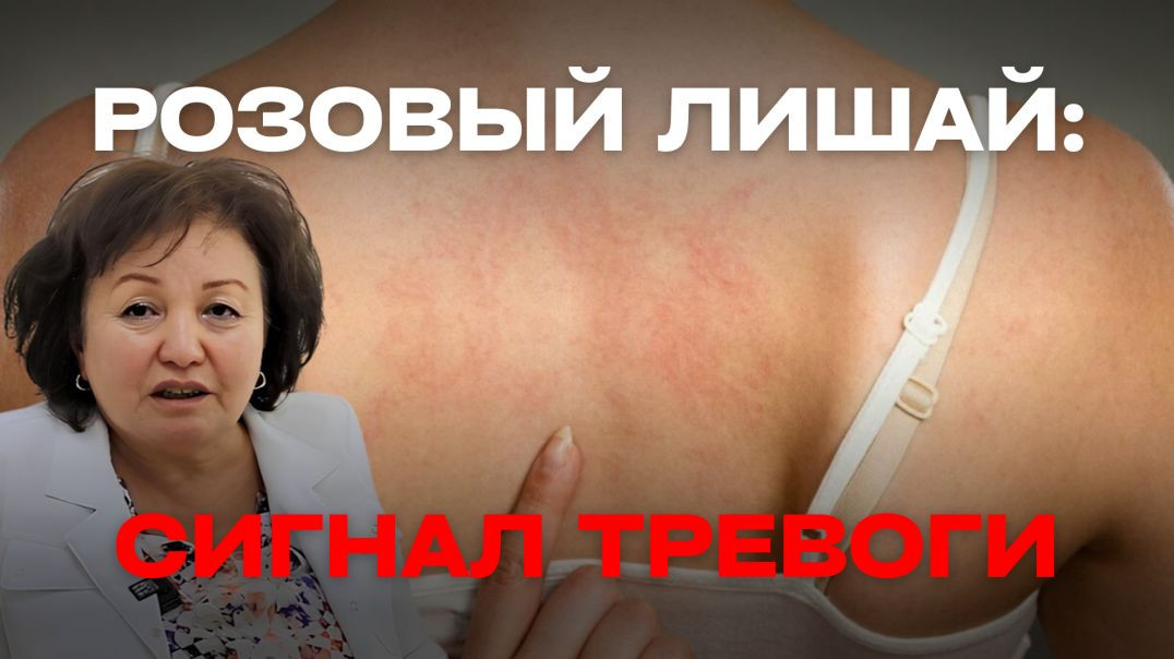 РОЗОВЫЙ ЛИШАЙ: СИГНАЛ ТРЕВОГИ