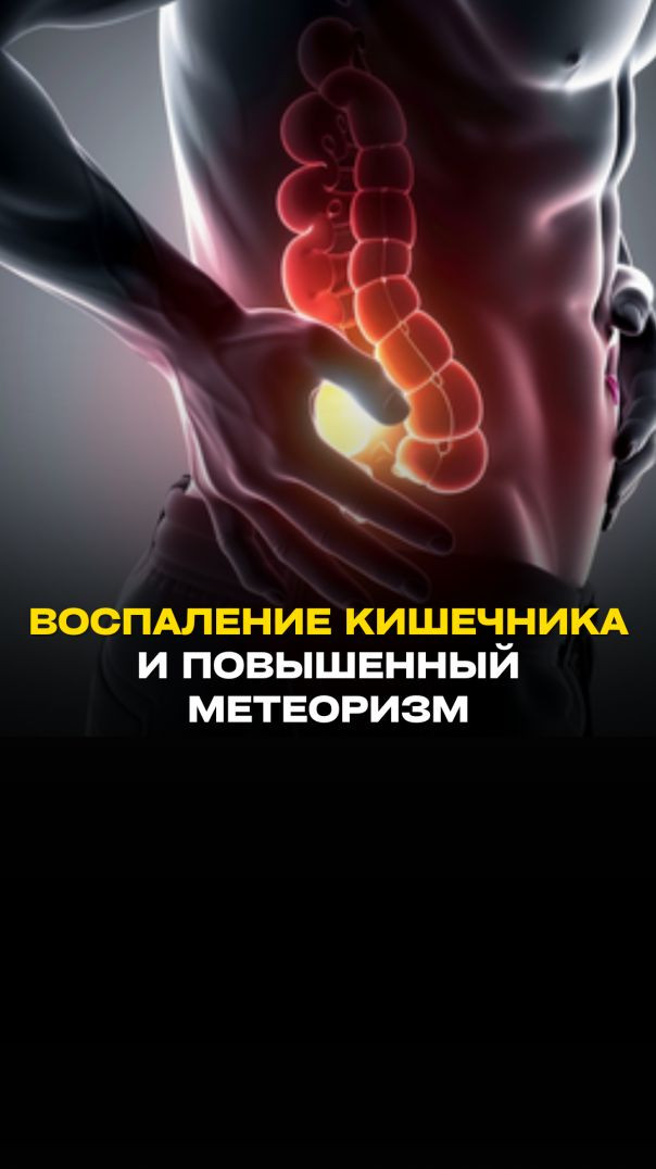 ВОСПАЛЕНИЕ КИШЕЧНИКА