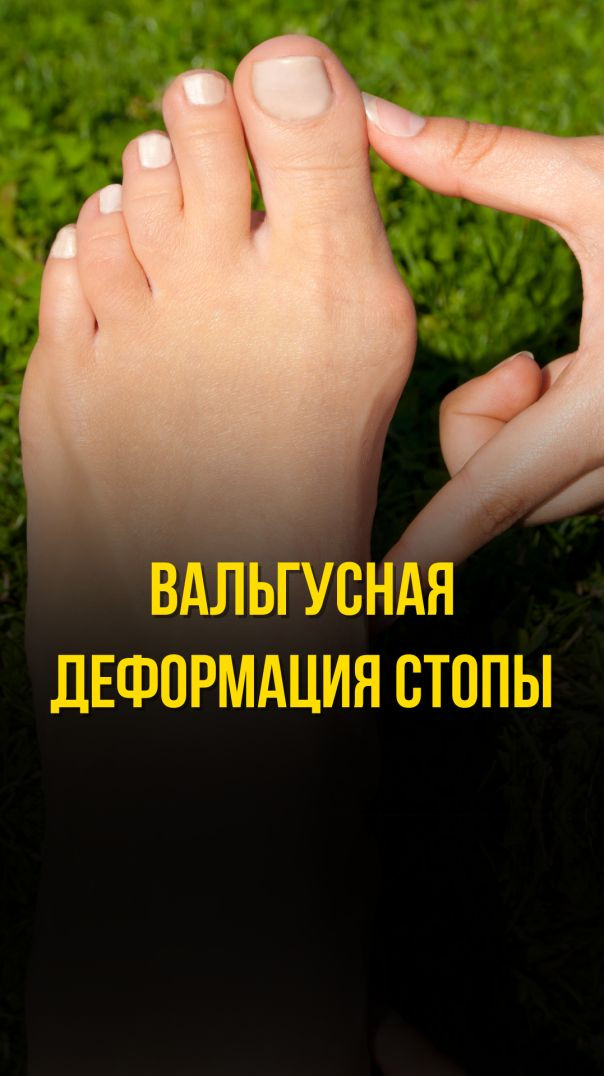 ВАЛЬГУСНАЯ ДЕФОРМАЦИЯ СТОПЫ