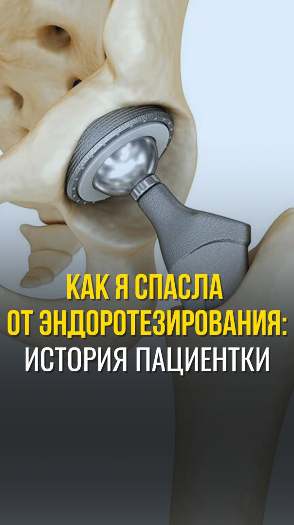 КАК Я СПАСЛА ОТ ЭНДОПРОТЕЗИРОВАНИЯ
