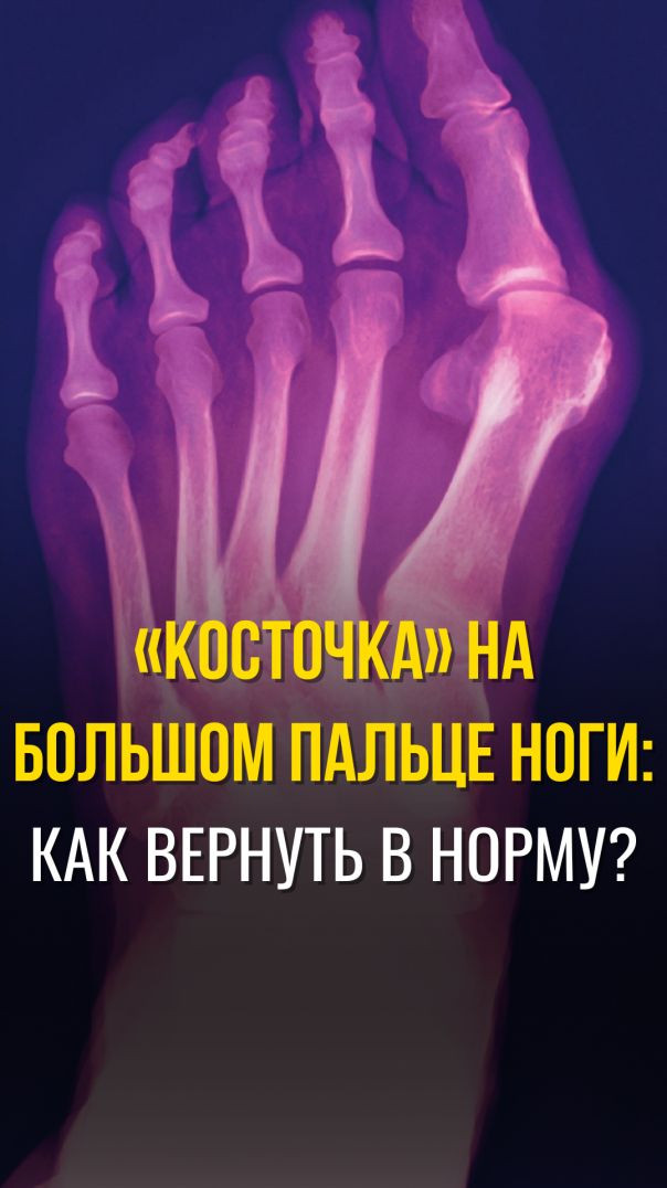 «КОСТОЧКА» НА БОЛЬШОМ ПАЛЬЦЕ НОГИ: КАК ВЕРНУТЬ В НОРМУ?
