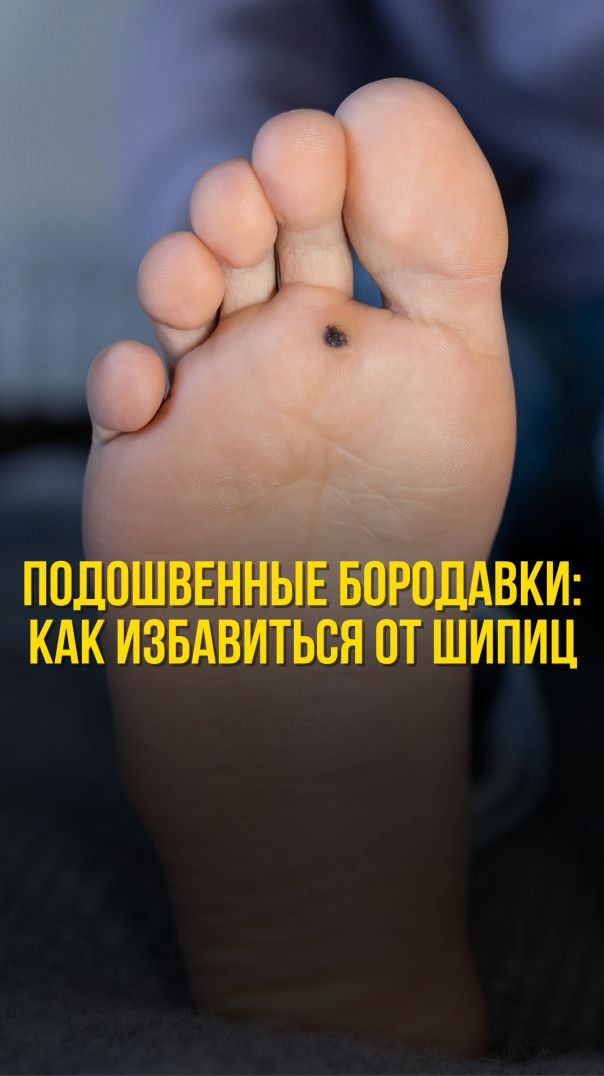 ПОДОШВЕННЫЕ БОРОДАВКИ: КАК ИЗБАВИТЬСЯ ОТ ШИПИЦ