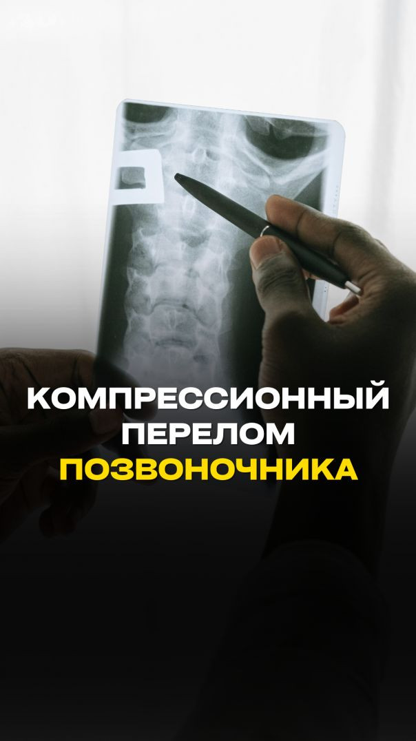 КОМПРЕССИОННЫЙ ПЕРЕЛОМ ПОЗВОНОЧНИКА