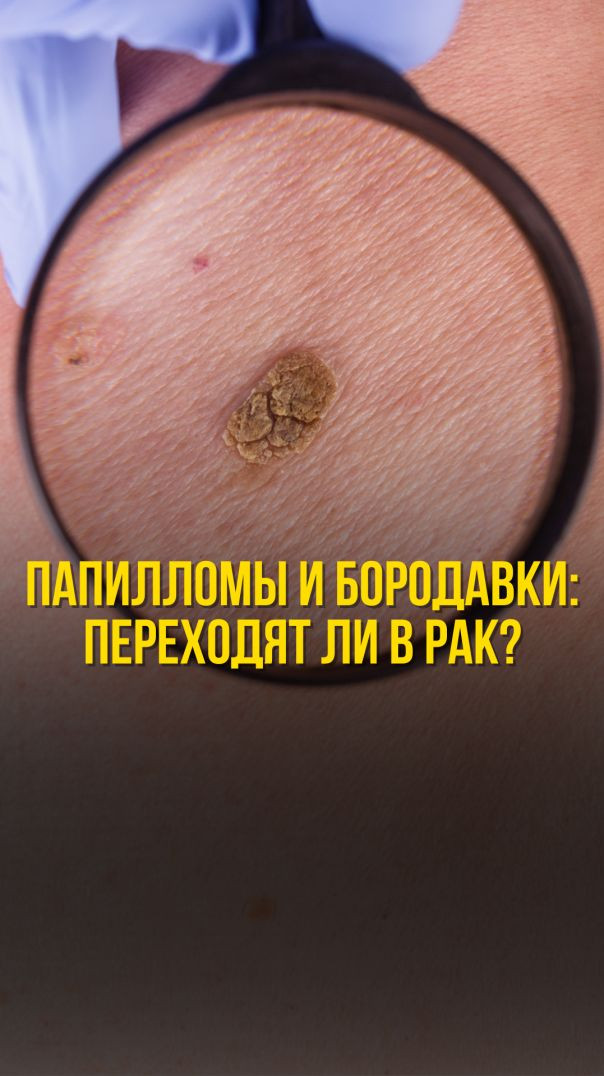 ПАПИЛЛОМЫ И БОРОДАВКИ ПЕРЕХОДЯТ ЛИ В РАК?