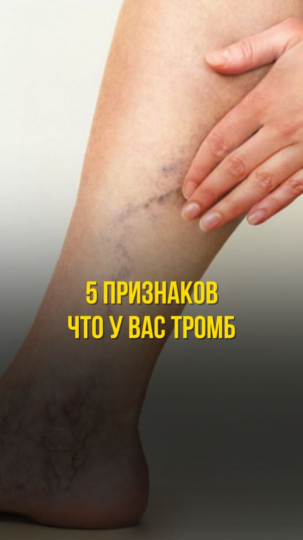 5 ПРИЗНАКОВ, ЧТО У ВАС ТРОМБ