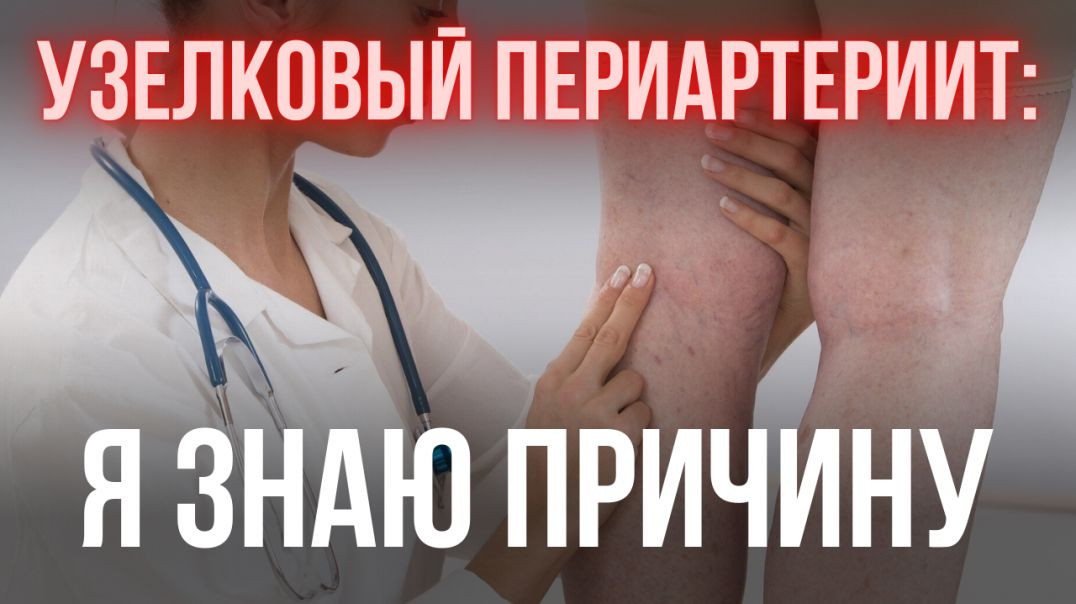 УЗЕЛКОВЫЙ ПЕРИАРТЕРИИТ: Я ЗНАЮ ПРИЧИНУ