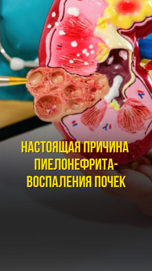 НАСТОЯЩАЯ ПРИЧИНА ВОСПАЛЕНИЯ ПОЧЕК