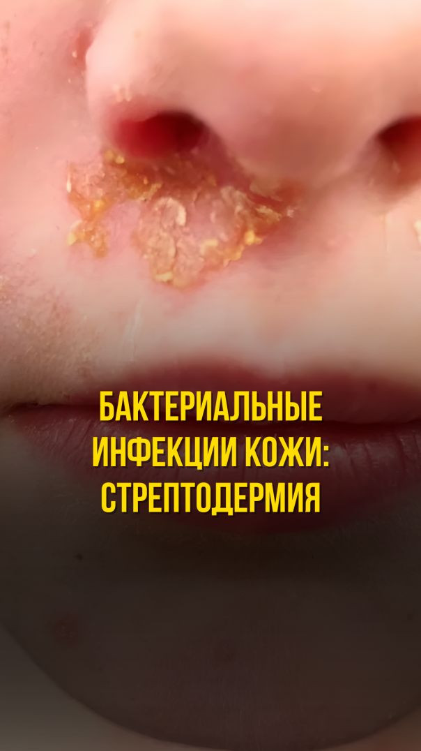 БАКТЕРИАЛЬНЫЕ ИНФЕКЦИИ КОЖИ: СТРЕПТОДЕРМИЯ
