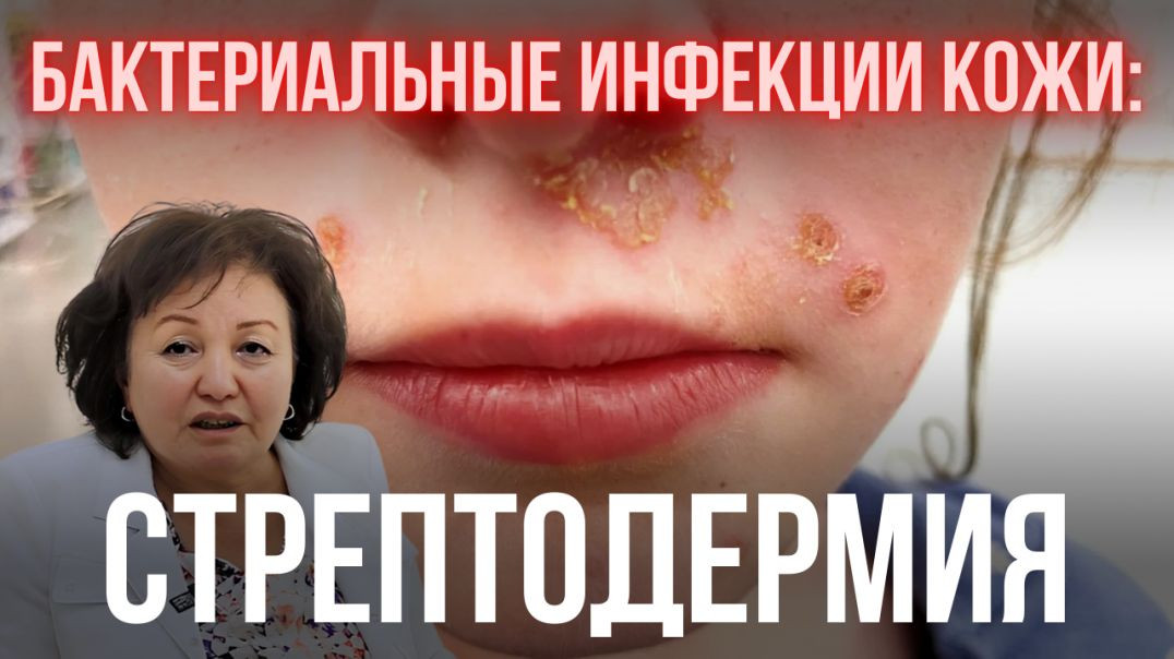 БАКТЕРИАЛЬНЫЕ ИНФЕКЦИИ КОЖИ: СТРЕПТОДЕРМИЯ
