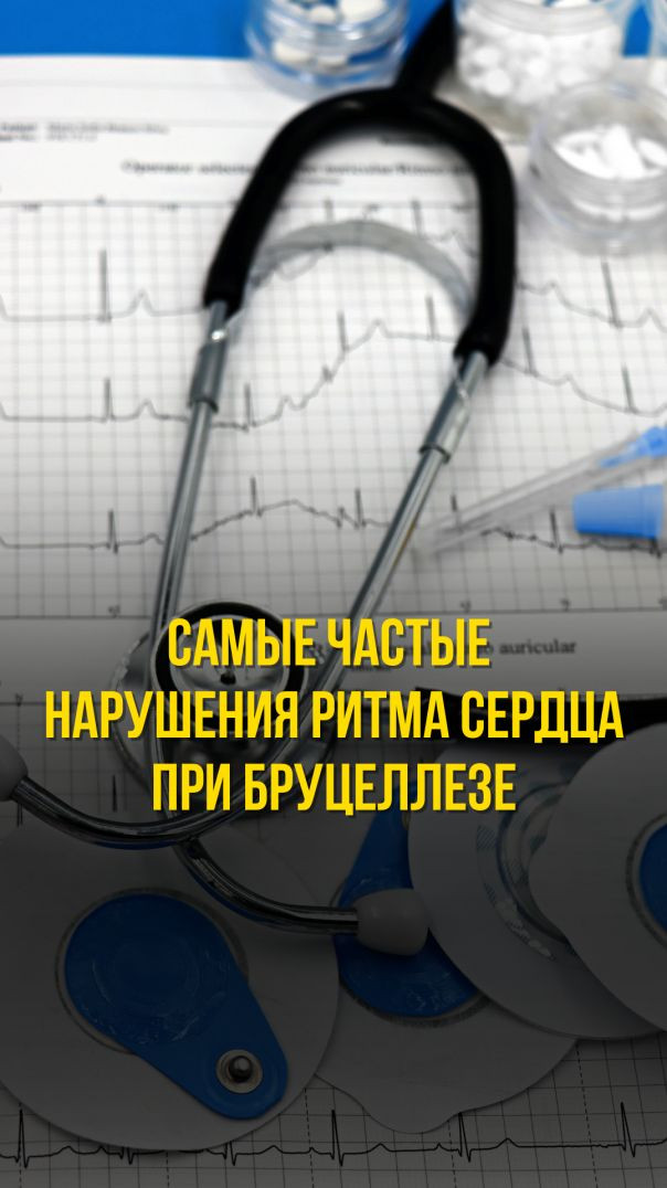 САМЫЕ ЧАСТЫЕ НАРУШЕНИЯ РИТМА СЕРДЦА ПРИ БРУЦЕЛЛЕЗЕ