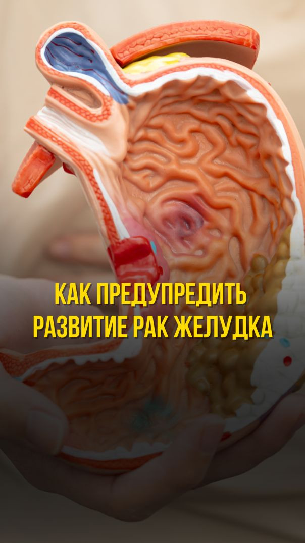 НЕ ПРОПУСТИТЕ СИМПТОМЫ РАКА ЖЕЛУДКА