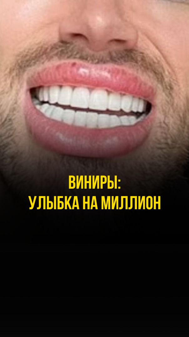 ВИНИРЫ: УЛЫБКА НА МИЛЛИОН