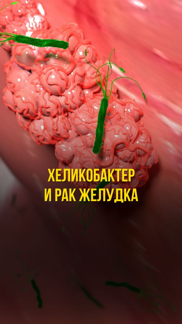 ХЕЛИКОБАКТЕР И РАК ЖЕЛУДКА Тизер