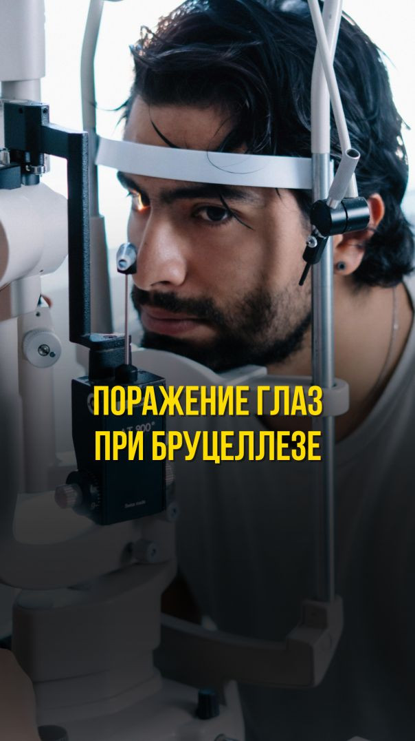 ПОРАЖЕНИЕ ГЛАЗ ПРИ БРУЦЕЛЛЕЗЕ Тизер