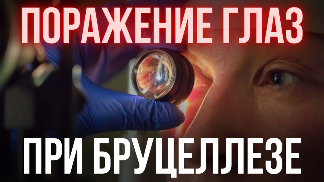 ПОРАЖЕНИЕ ГЛАЗ ПРИ БРУЦЕЛЛЕЗЕ