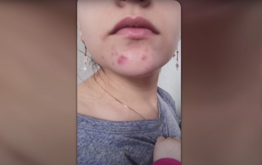 Последствия использования неоригинальной пенки для умывания. Фото youtube.com/user/katyavitkind