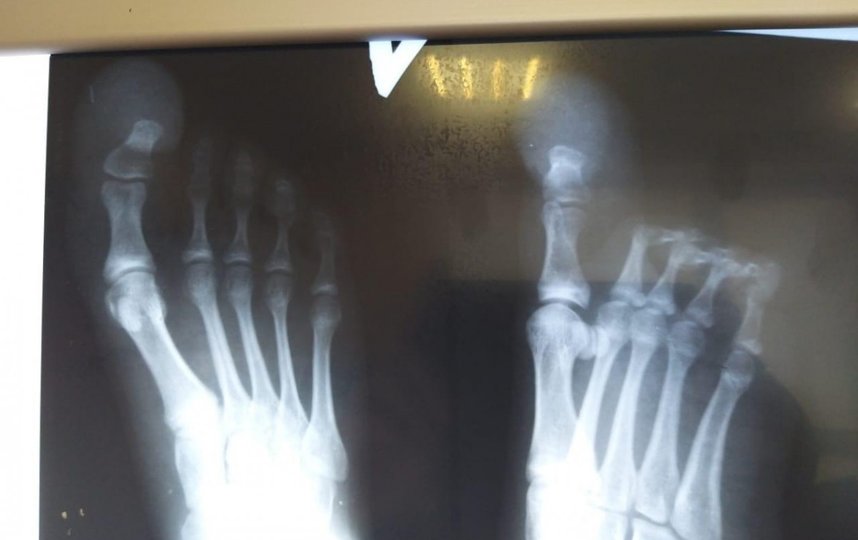 "В мире таких 150": врачи в Мытищах вылечили девочку с гигантизмом большого пальца стопы