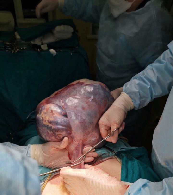 В Подмосковье у пожаловавшейся на боли в животе пенсионерки обнаружили 15-килограммовую опухоль. Фото скриншот mz.mosreg.ru/