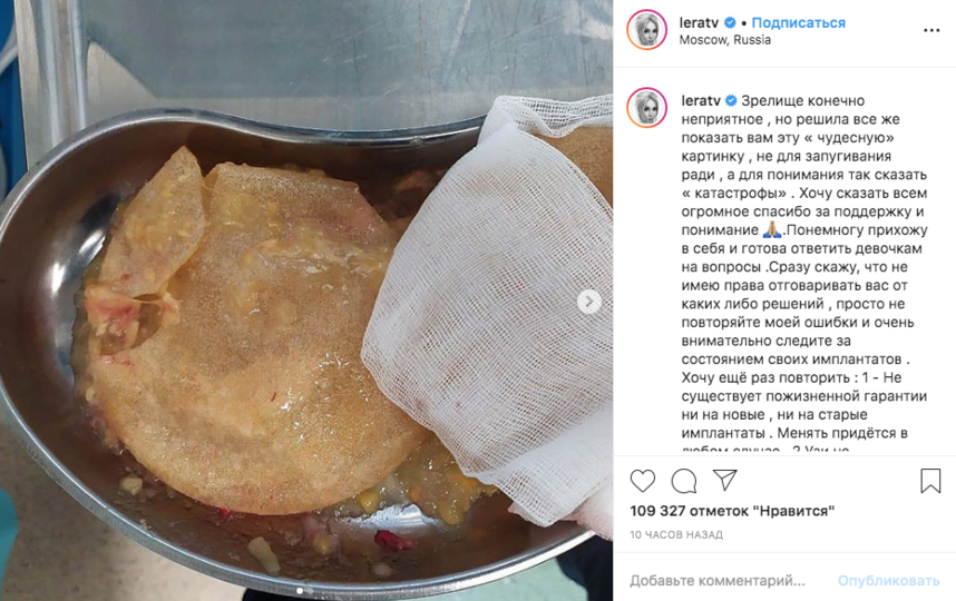 Лера Кудрявцева показала фото разорванного грудного импланта