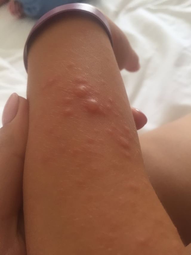 Дети, пострадавшие от вируса Коксаки. Фото Фото предоставлено Марией Сакович.