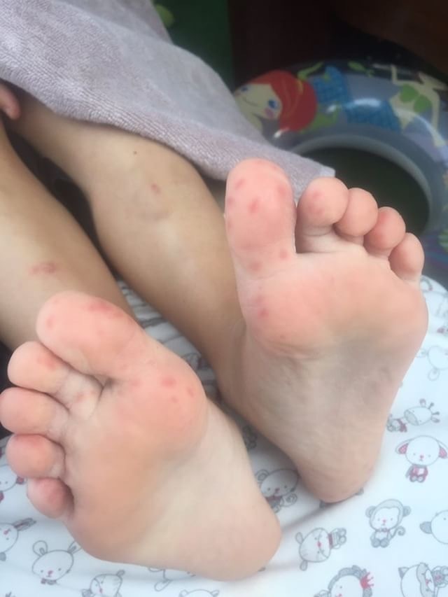 Дети, пострадавшие от вируса Коксаки. Фото Фото предоставлено Марией Сакович.