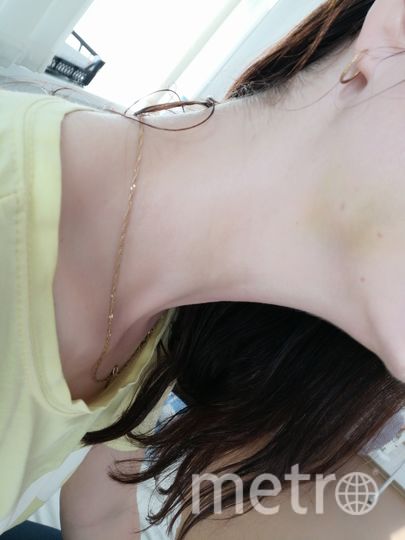 Алла не хочет показывать целиком всю рану, поскольку говорит, что выглядит она ужасно. Фото предоставила Алла, "Metro"
