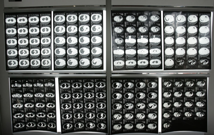 Рентген ракового больного. Фото Getty