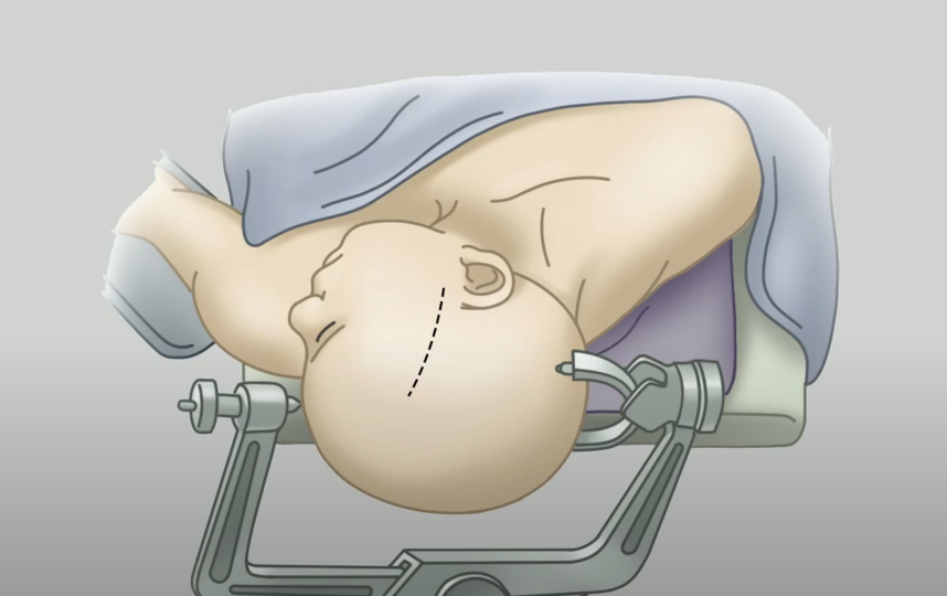 Иллюстрация процесса вживления чипа. Фото Скриншот презентации Neuralink, Скриншот Youtube