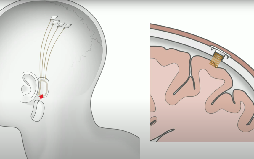 Предполагаемое местонахождение чипа. Фото Скриншот презентации Neuralink, Скриншот Youtube