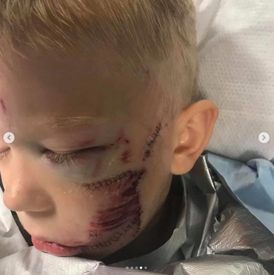 Бриджеру наложили около 90 швов. Фото Instagram @nicolenoelwalker