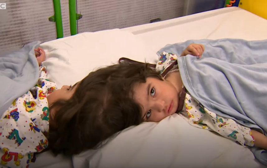 Двухлетние сёстры Сафа и Марва из Пакистана родились со сросшимися черепами и общими кровеносными сосудами. Фото Скриншот https://www.youtube.com/watch?v=DfKTHPUigvc, Скриншот Youtube