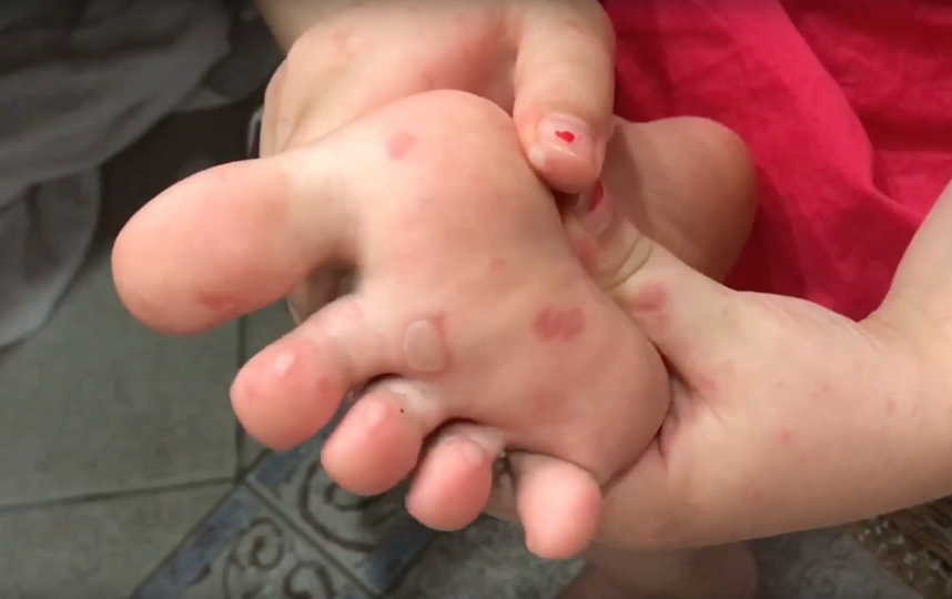 Вирус Коксаки. Фото Скриншот Youtube