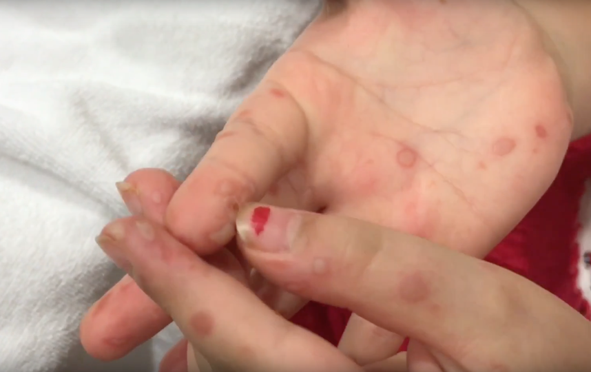 Вирус Коксаки. Фото Скриншот Youtube