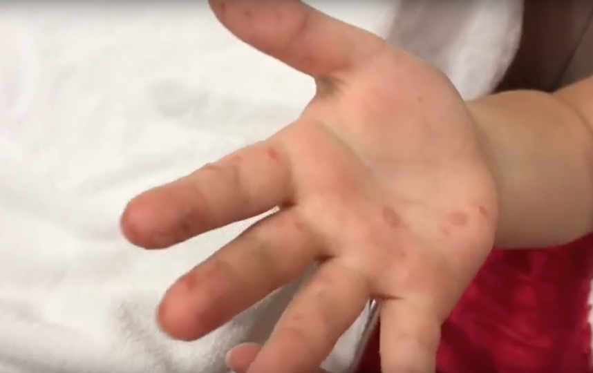 Вирус Коксаки. Фото Скриншот Youtube