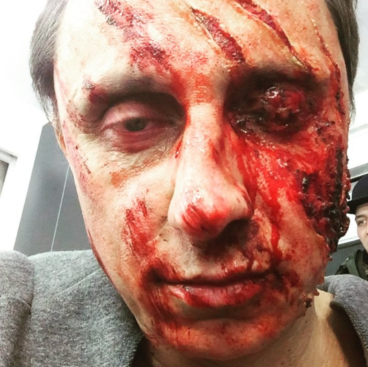 Вадим Галыгин разбил лицо, катаясь на тракторе