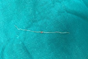 12-сантиметровый червь поселился в щеке россиянки после укуса комара