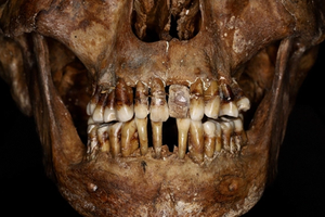 Как аристократы 17 века пытались сохранить свои зубы