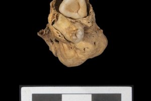 В древнеегипетском городе нашли могилу женщины с опухолью яичника