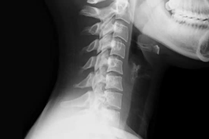 Британка сломала шею из-за неудачного зевка