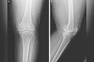 Врачи нашли в коленях пациентки сотни золотых нитей