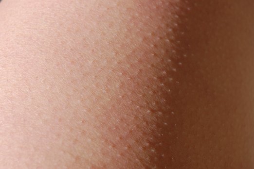 Откуда у нас мурашки и почему они больше не нужны?