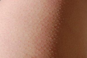 Откуда у нас мурашки и почему они больше не нужны?