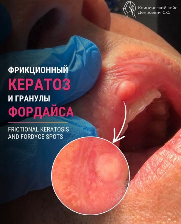 Фрикционный кератоз