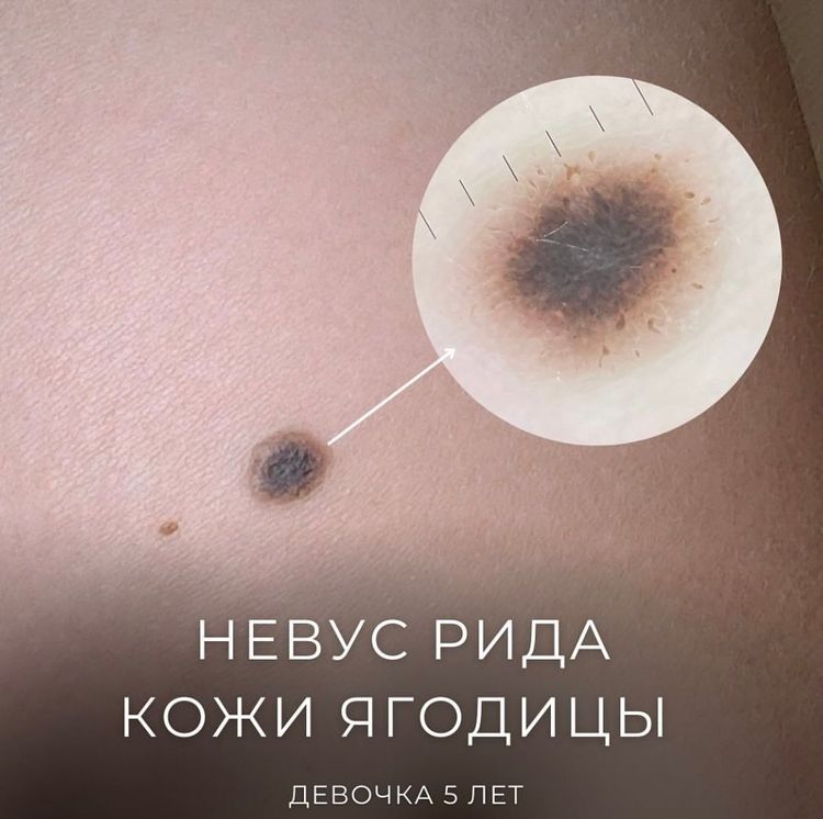 Невус Рида у ребенка