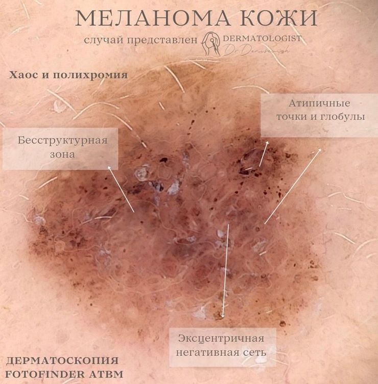Меланома на лице